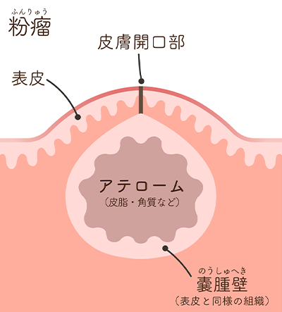 薬では治すことが出来ないため治療には外科手術が必要です