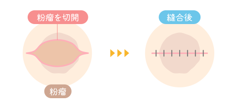 従来の切開法