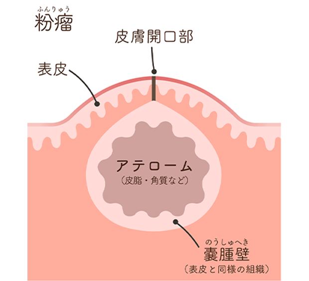 薬では治すことが出来ないため治療には外科手術が必要です