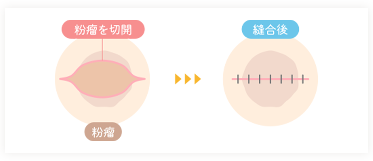 従来の切開法